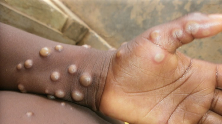 WHO reports 6,603 cases, 32 deaths of mpox in Africa